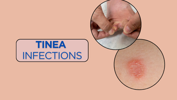 Tinea Infections